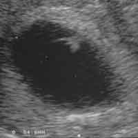 image of same womb after a missed miscarriage